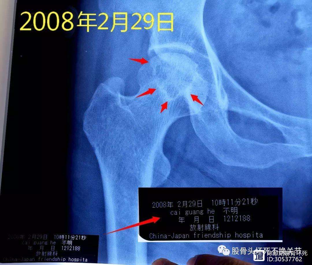 贵港人工骨头医保报销多少(人工骨头医保报销多少比例)